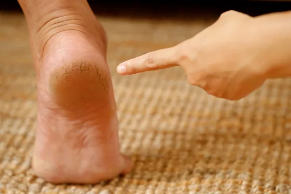 Do You Need to See a Podiatrist for Cracked Heels?