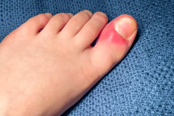 Ingrown Toenail Surgery in Dublin 9: What to Expect Before, During & After