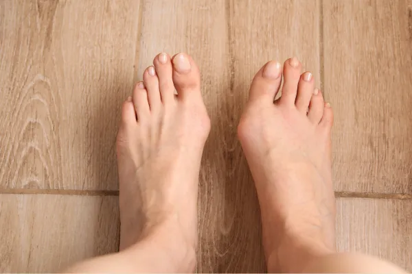 Do Toe Separators and Bunion Splints Really Work?