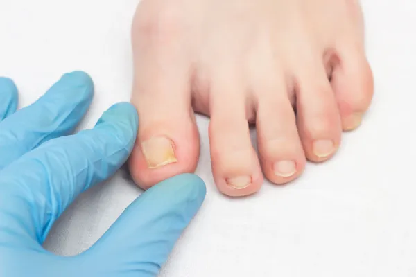 How Long Does Ingrown Toenail Surgery Take? Dublin Clinic Answers Your FAQs
