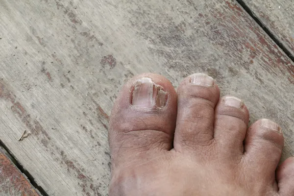 Do I Really Need Surgery for My Ingrown Toenail? Advice from a Dublin Podiatrist