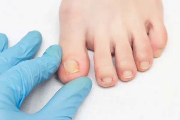 Image for Common Myths About Ingrown Toenail Surgery — Dublin 9 Foot Experts Clarify
