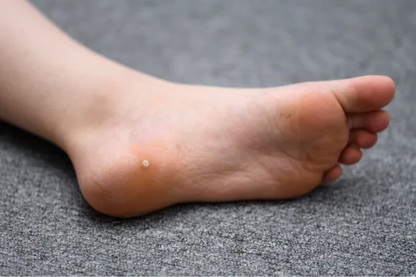 Image for Are Freezing Treatments for Verrucas Safe and Effective?