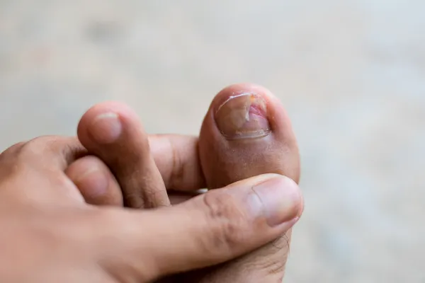 What Happens If You Leave a Damaged Toenail Untreated? Dublin 4 Advice