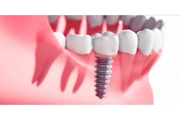 7 Advantages of Dental Implants Over
Dentures