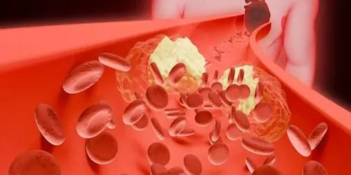 Rethinking Low Cholesterol: A Cardiologist Perspective