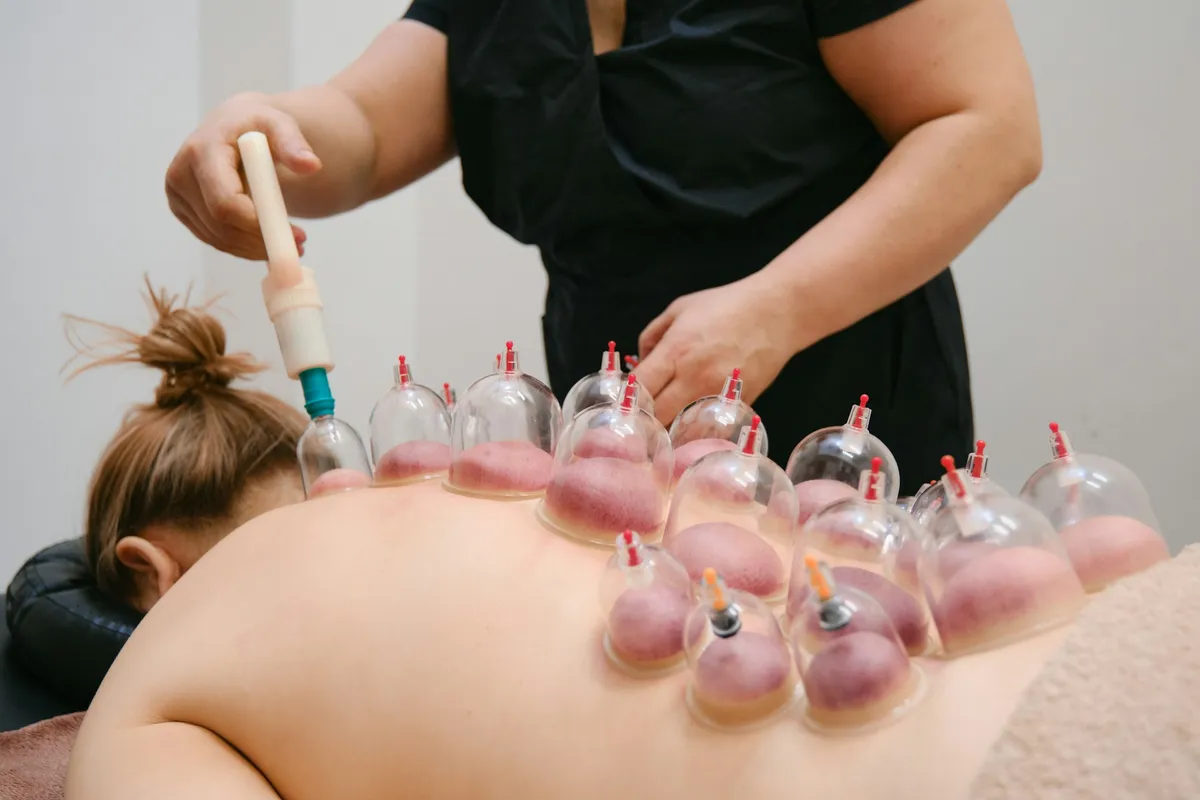 cupping therapy
