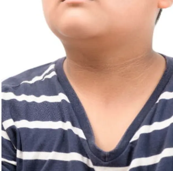 Acanthosis Nigricans My Skin  St Pete Bradenton