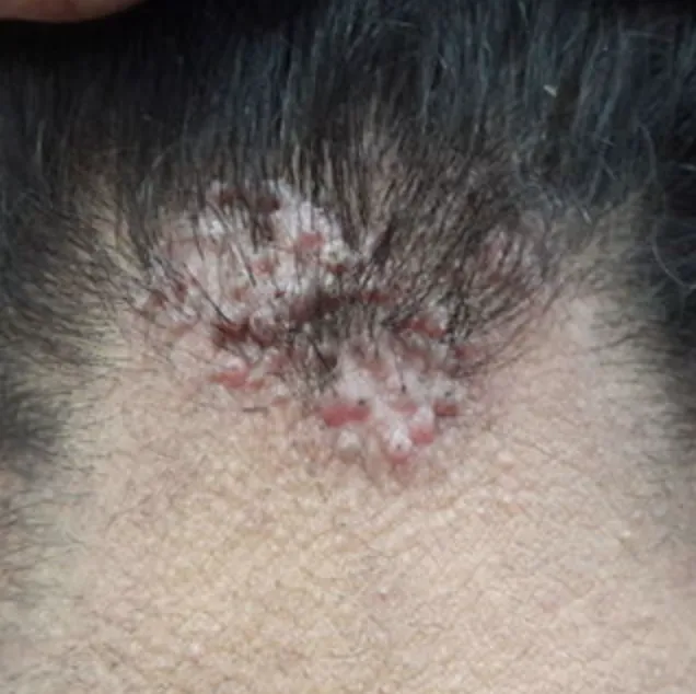Acne Keloidalis Nuchae My Skin St Pete Bradenton