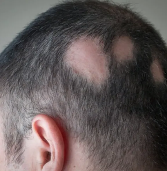 Alopecia Areata | My Skin