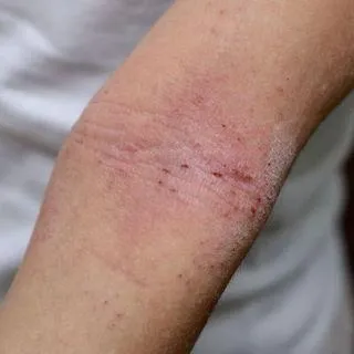 Atopic Dermatitis My Skin St Pete Bradenton