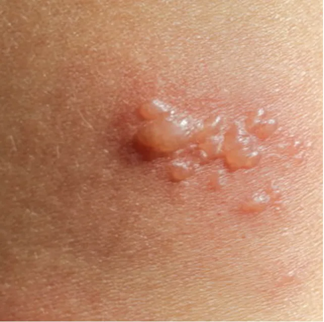 Bullous Pemphigoid | My Skin