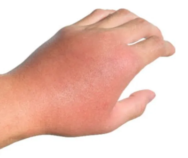 Cellulitis