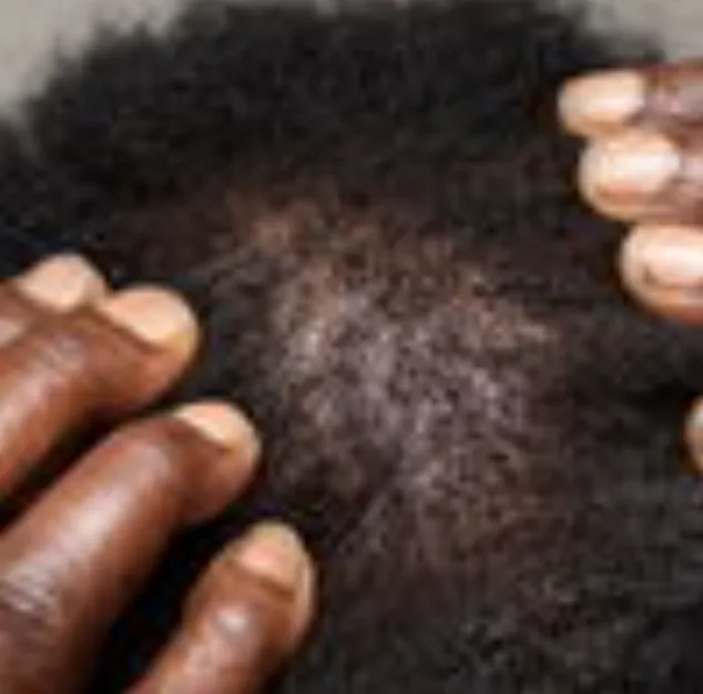 Central Centrifugal Cicatricial Alopecia | My Skin