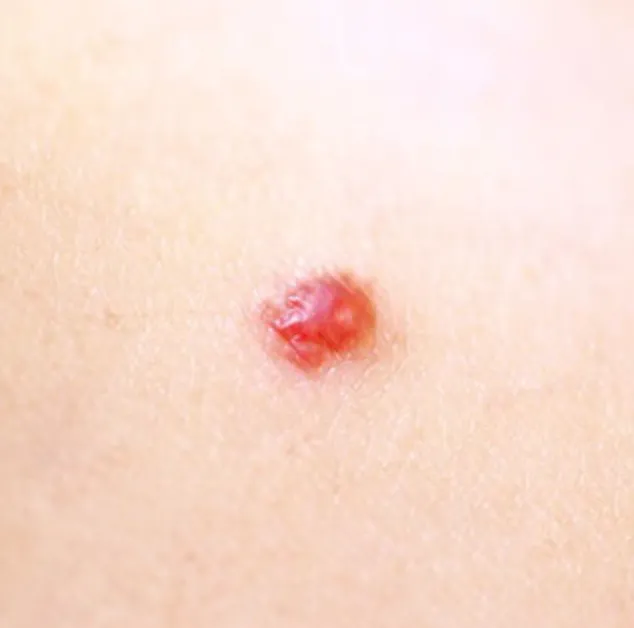 Cherry Angiomas | My Skin