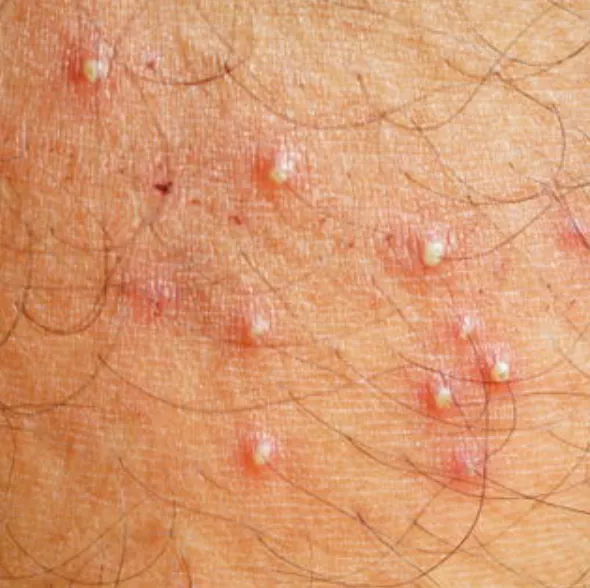 Folliculitis | My Skin