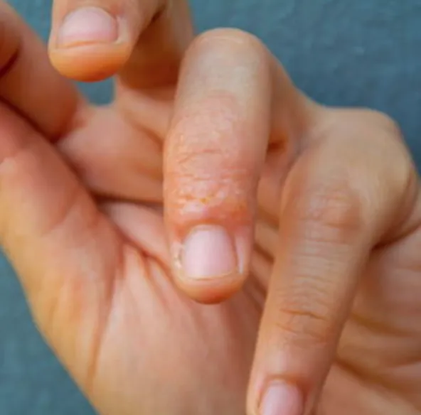 Dyshidrotic Eczema