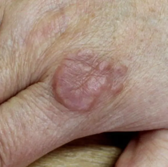 Granuloma Annulare | My Skin