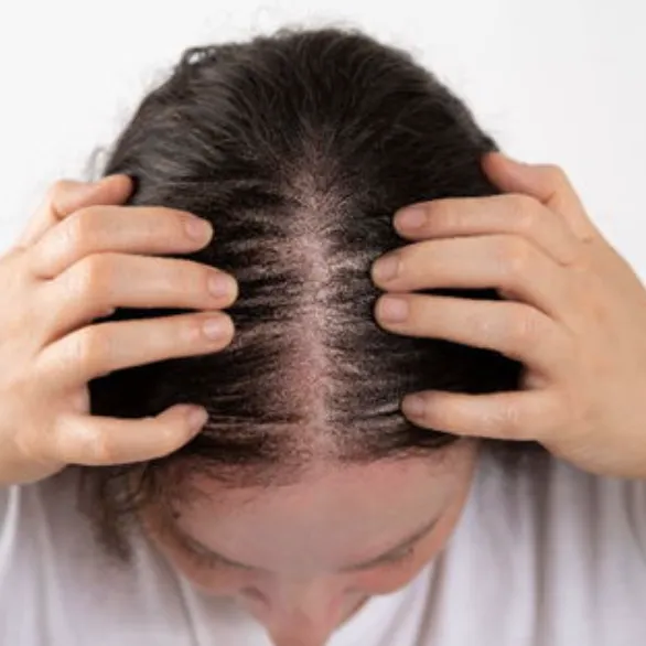 Female Pattern Hair Loss | My Skin