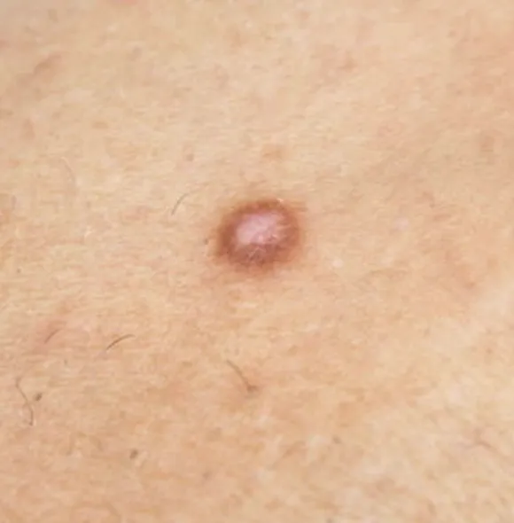 Dermatofibroma | My Skin