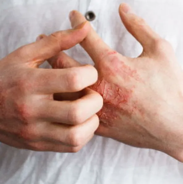 Eczema (Dermatitis)