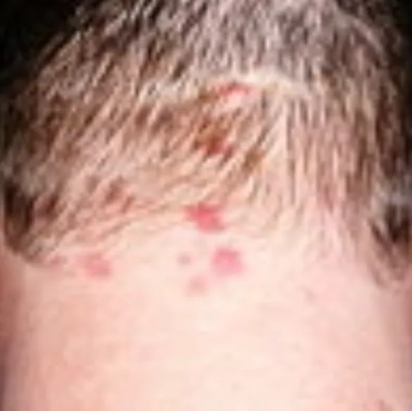 Dermatitis Herpetiformis | My Skin