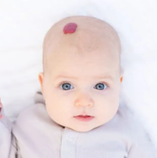 Infantile Hemangiomas My Skin