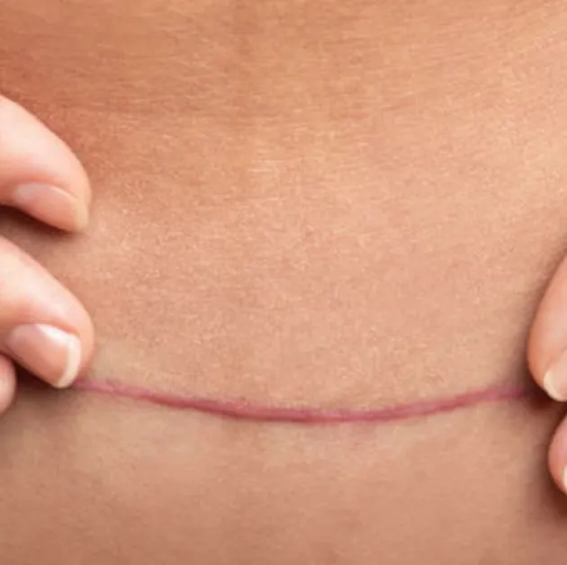 Hypertrophic Scars
