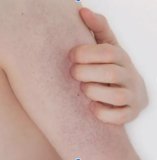 Keratosis Pilaris | My Skin