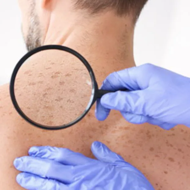 Lentigo/Lentigines | My Skin