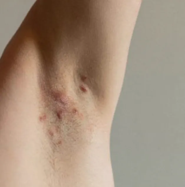 Hidradenitis Suppurativa | My Skin