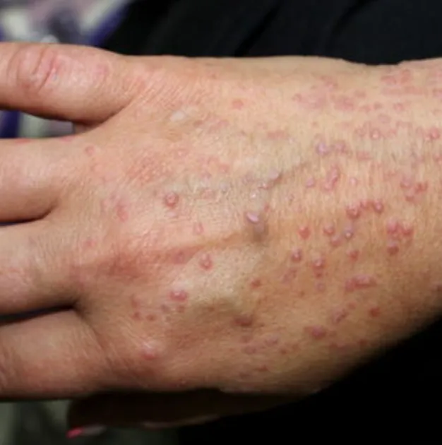 Lichen Planus | My Skin