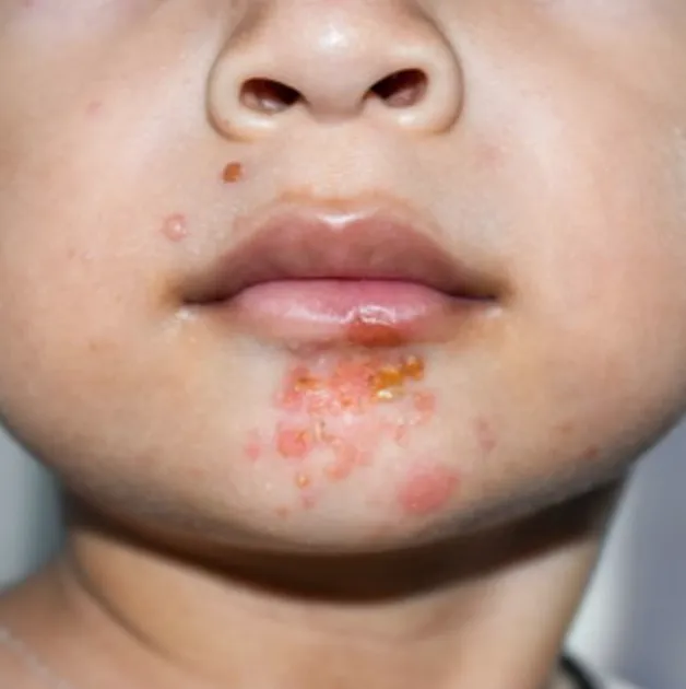 Impetigo