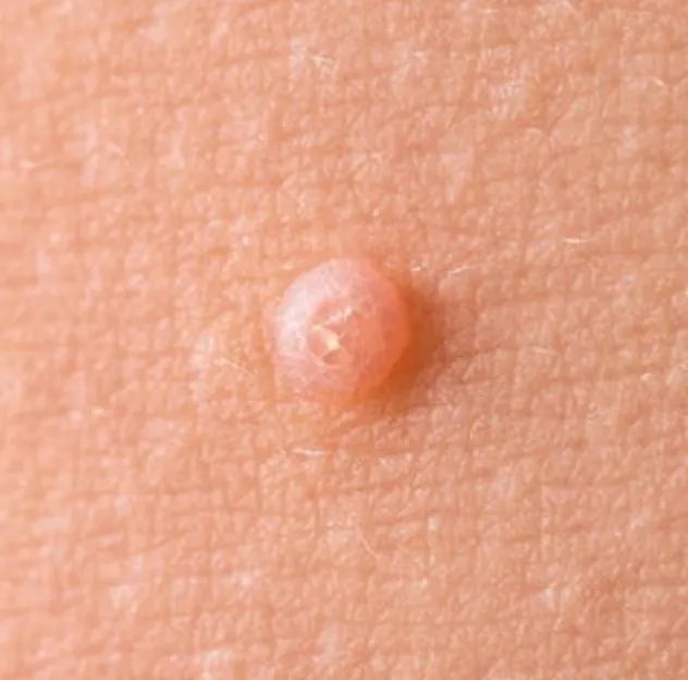 Molluscum Contagiosum