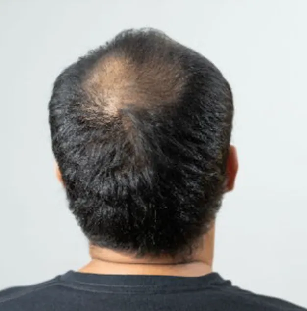 Male Pattern Hair Loss (Androgenetic Alopecia)