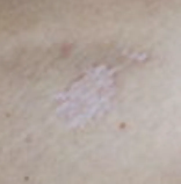 Lichen Sclerosus | My Skin Dermatology