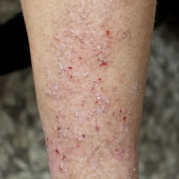 Lichen Simplex Chronicus | My Skin
