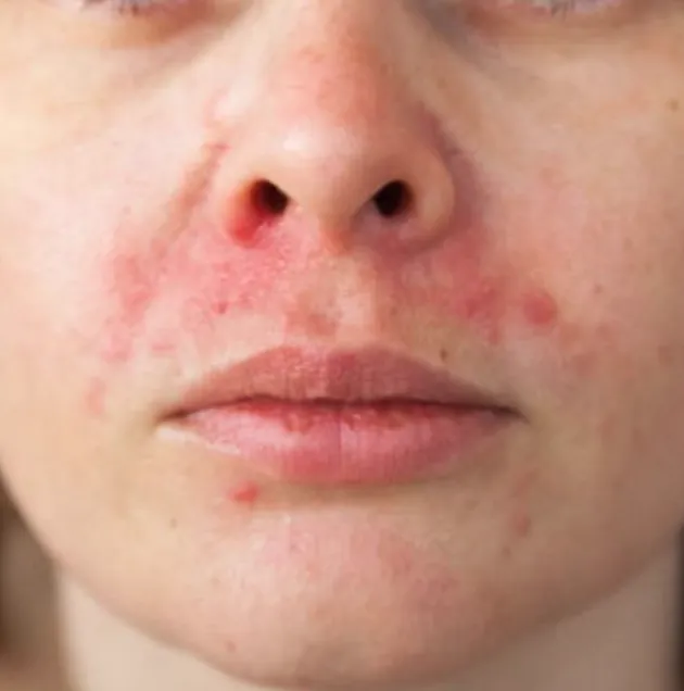 Perioral Dermatitis