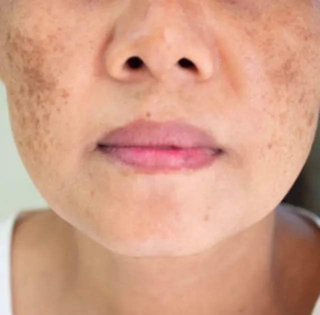 Melasma