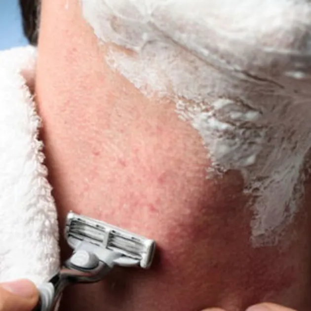 Pseudofolliculitis Barbae: Razor Bumps Explained
 | My Skin