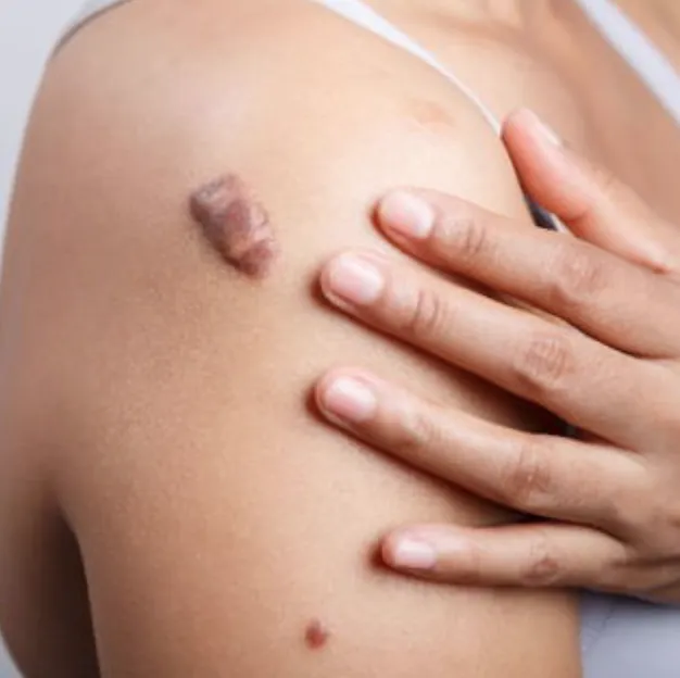 Keloids | My Skin