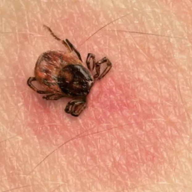 Lyme Disease | My Skin Dermatology