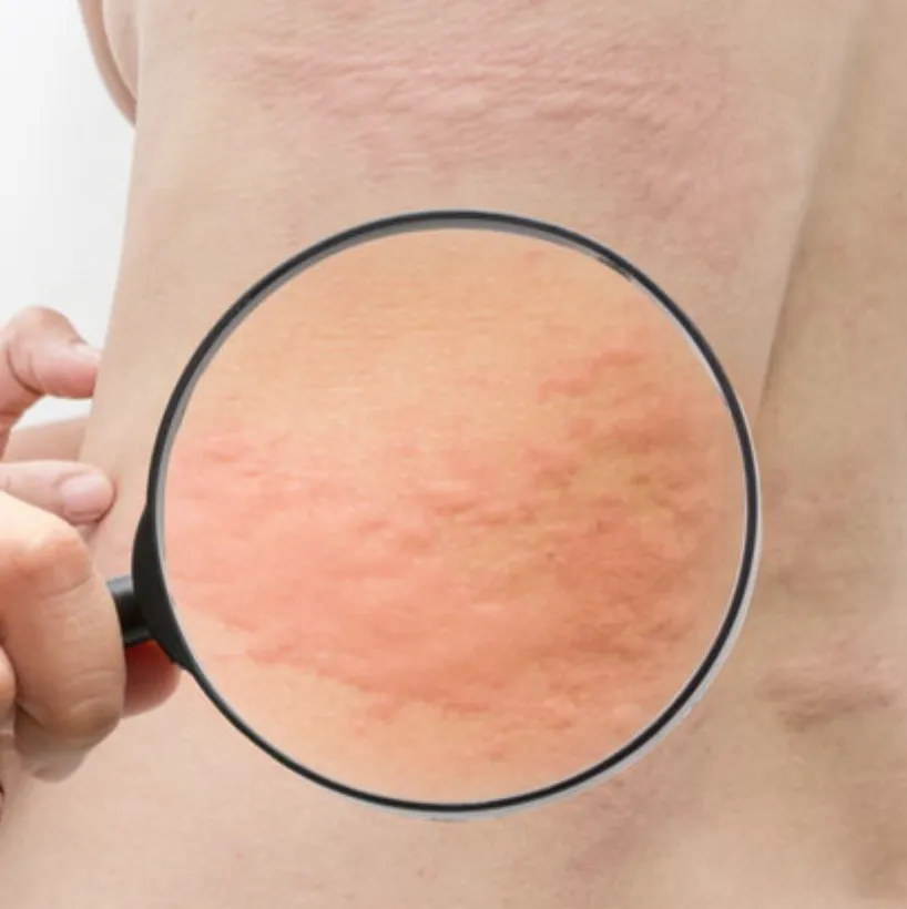 Urticaria: Causes, Symptoms, and Effective Treatments | Leah Michel APRN, FNP-BC
