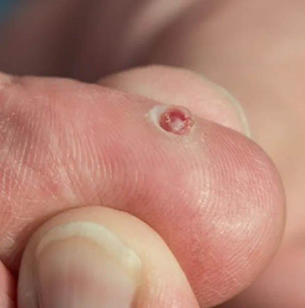 Pyogenic Granuloma