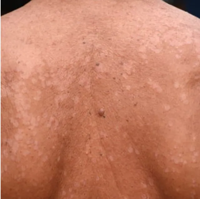Tinea Versicolor