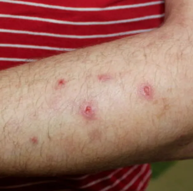Prurigo Nodularis