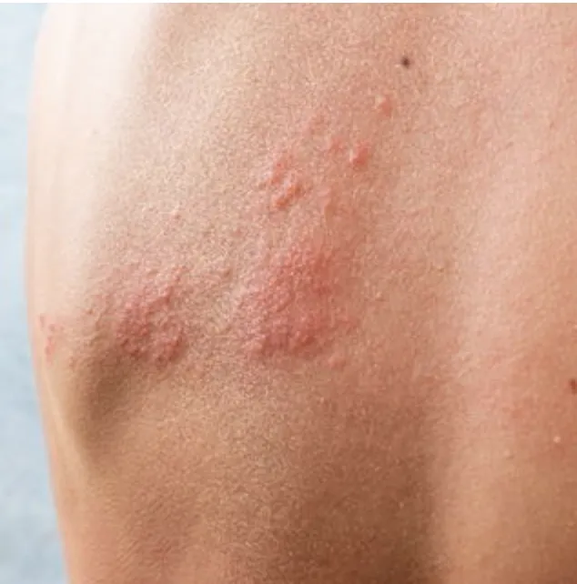 Protect Yourself: Shingles Prevention & Treatment Options
| My Skin