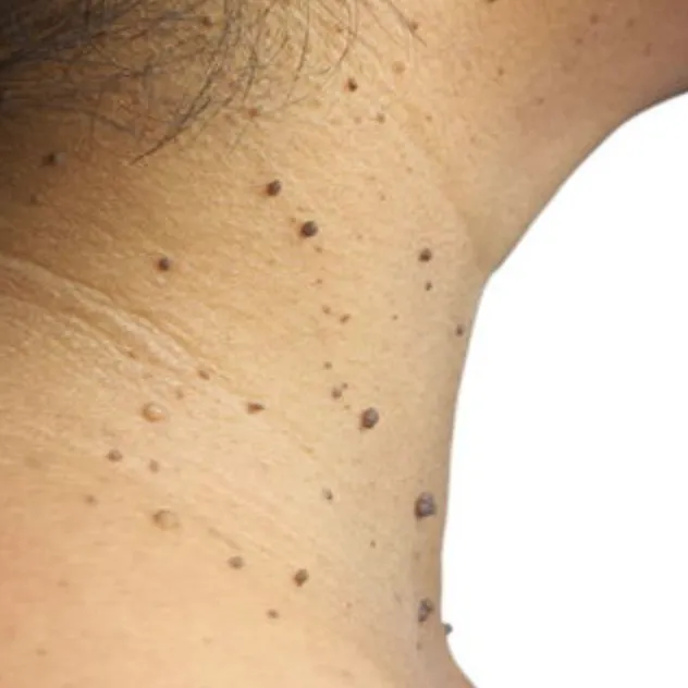 Skin Tags