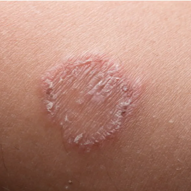 Beyond the Itch: Unveiling the World of Tinea Infections | Leah Michel APRN, FNP-BC