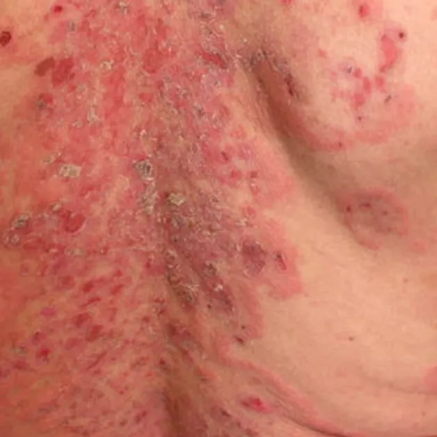Pemphigus